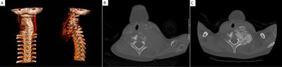 Mineral and Bone Consequences of High Dose Denosumab Therapy to Treat an Aneurysmal Bone Cyst, a Child Case Report